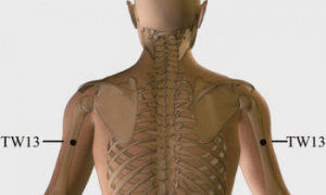 tw13 acupuncture for tooth pain relief